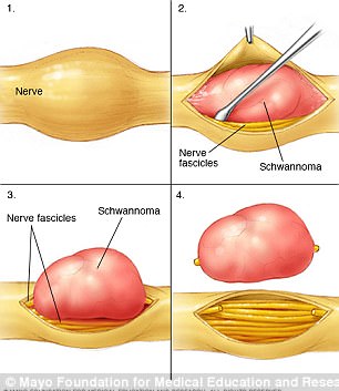 chwannomas are tumors that begin to grow around nerves, inside their protective sheaths