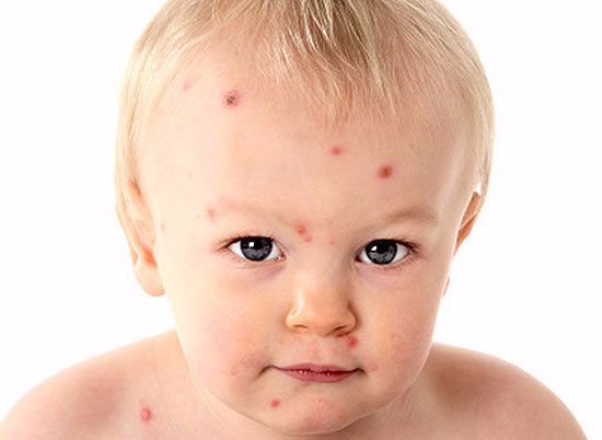 Spotty Logic: Mandated Chicken Pox Vaccine for school