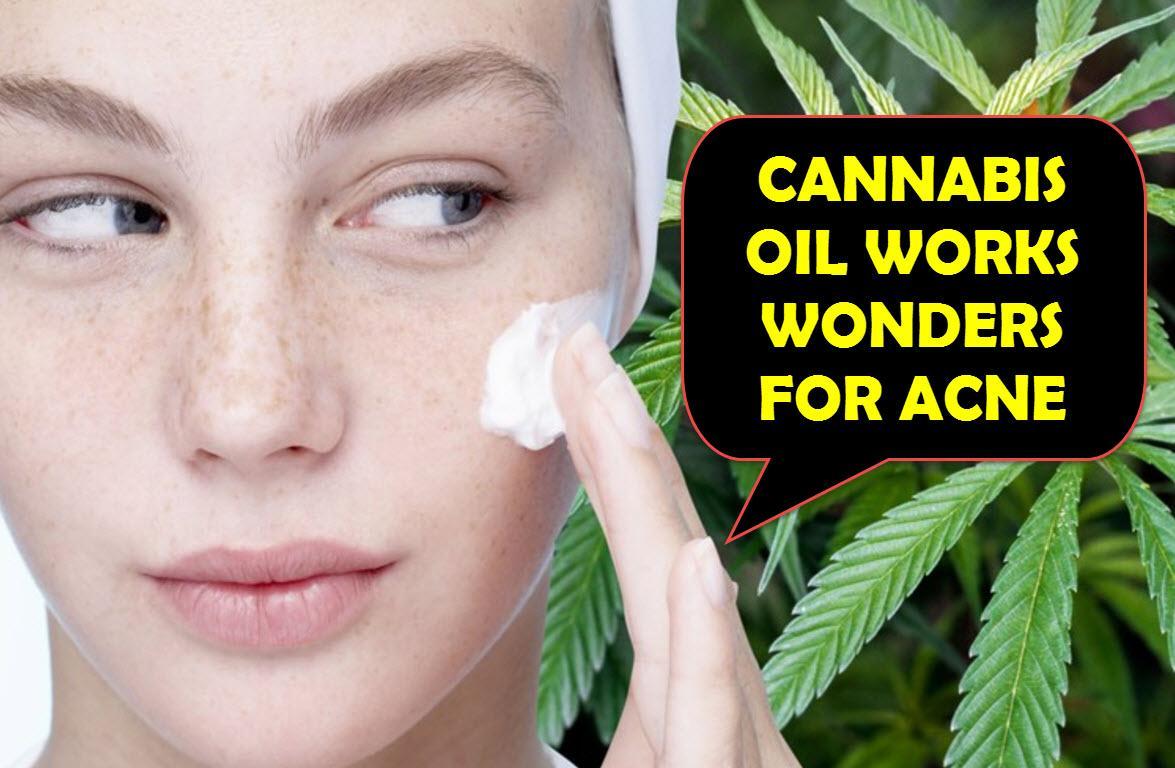 Image result for acne relief from CBD