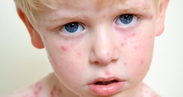 Herbal suggestions in treating Chicken Pox