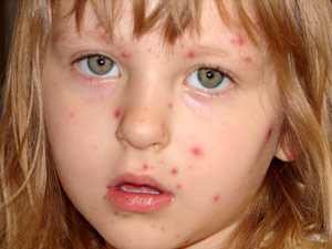 Warning: Vaccine could spread CHICKENPOX