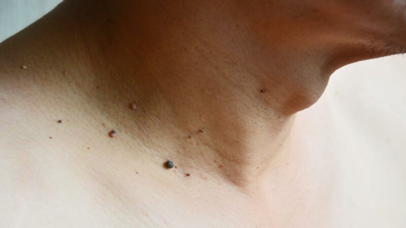 Removing Moles, Warts and Skin Tags Naturally