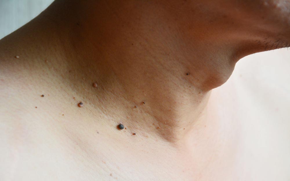 Removing Moles, Warts and Skin Tags Naturally